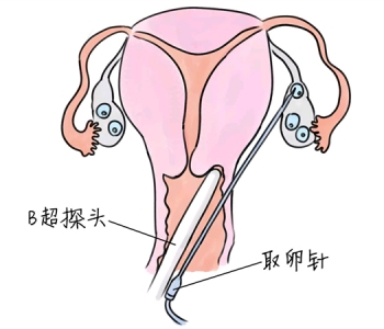 小儿退烧推拿手法 5种郑州捐卵宝宝退烧按摩方法